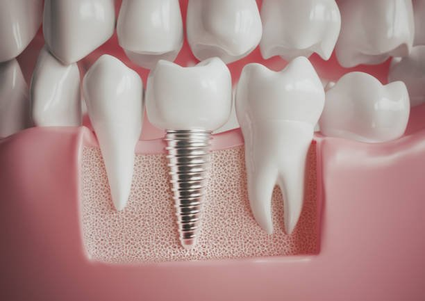 Best Dental implant treatment in Muzaffarnagar