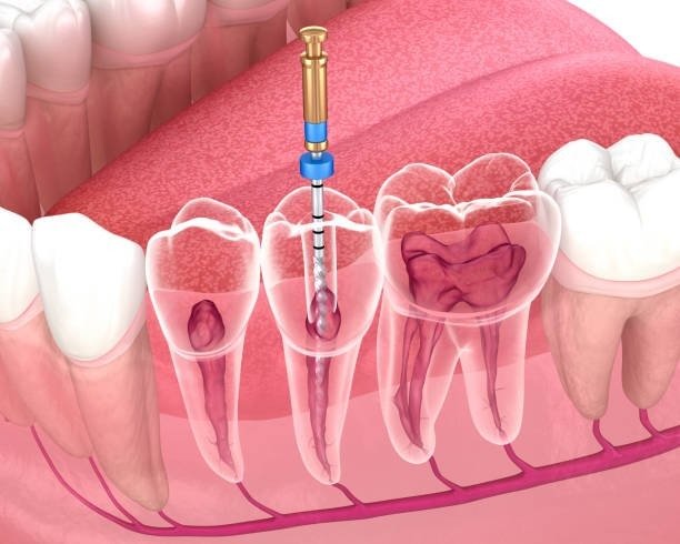 Best Root Canal Specialist in Muzaffarnagar