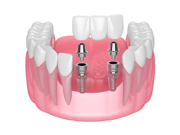 Best Crowns and Bridges treatment in Muzaffarnagar