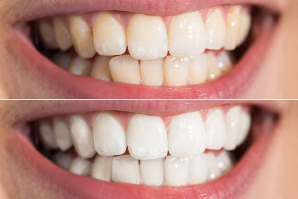 Best Teeth Whitening Treatment in Muzaffarnagar