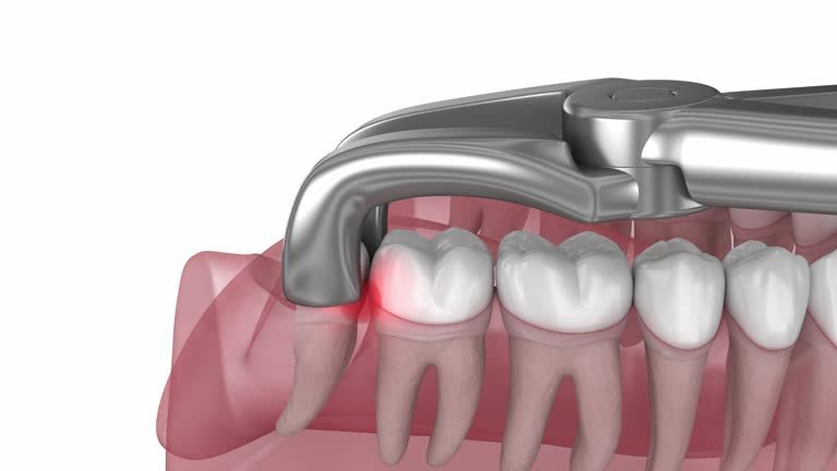 Best Wisdom Tooth Removal Treatment in Muzaffarnagar