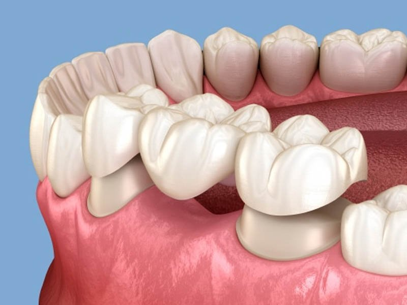 Best Full mouth rehabilitation treatment in Muzaffarnagar