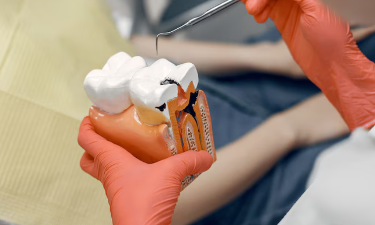 Best Root Canal Treatment in Meerut