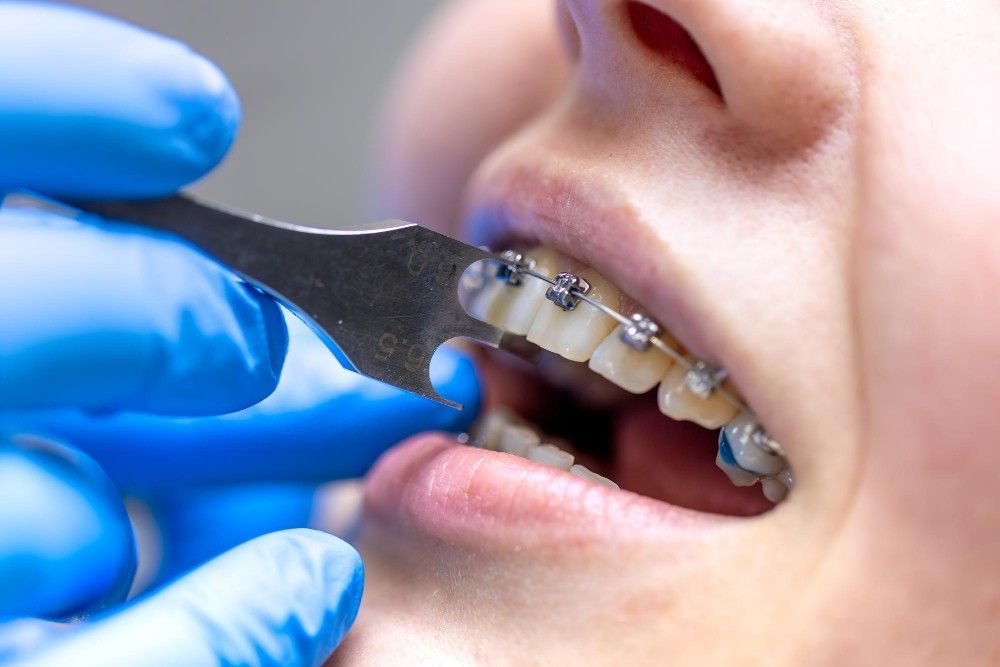 Best Orthodontist in Muzaffarnagar