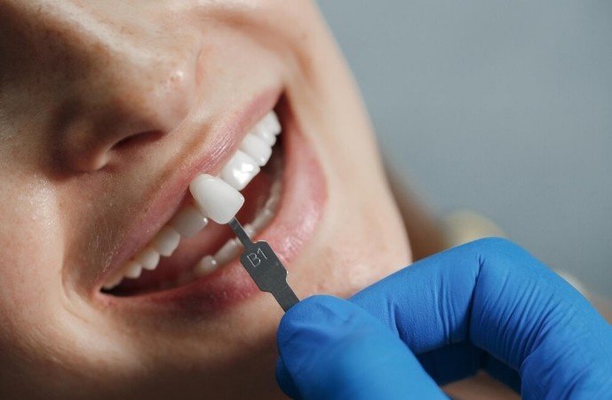 Best Crown and Bridges Treatment in Muzaffarnagar