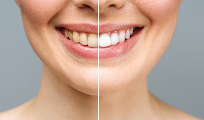 Best Teeth Whitening Clinic in Muzaffarnagar