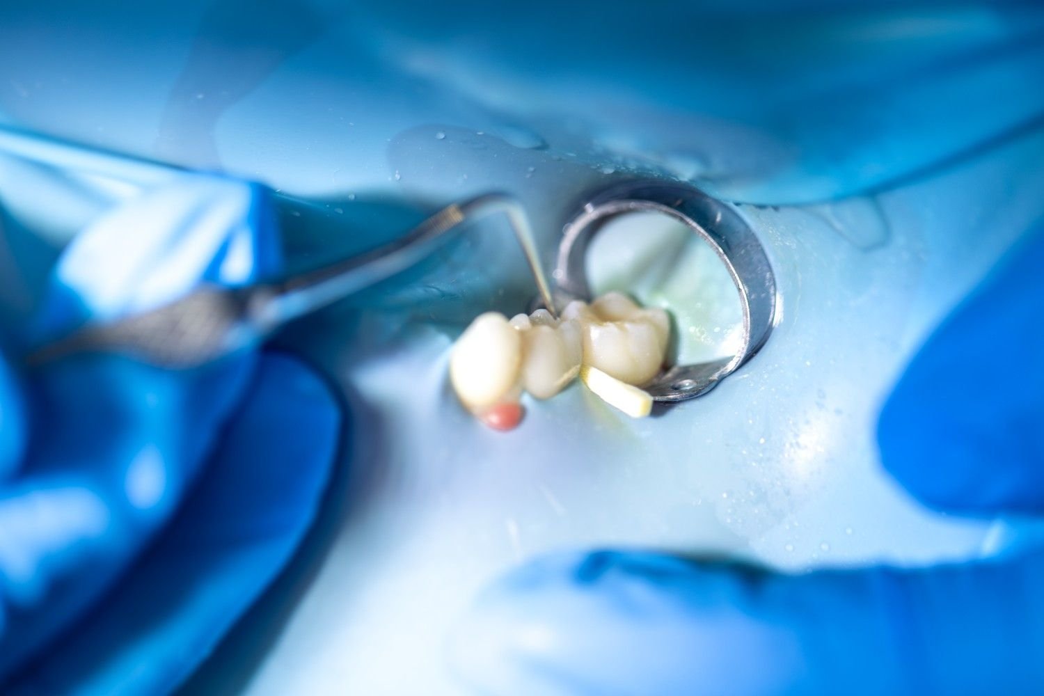 Wisdom Tooth Removal Service in Muzaffarnagar