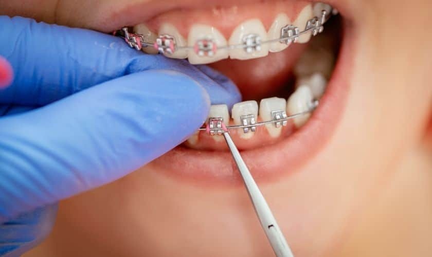 Best Orthodontic Treatment in Bijnor