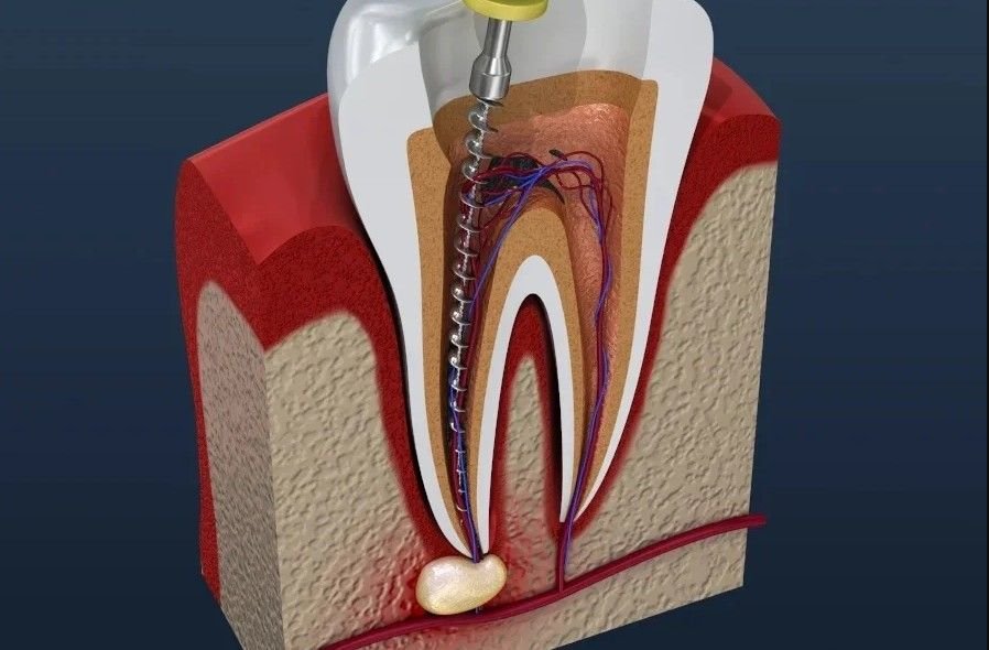 Best Root Canal Specialist in Bijnor